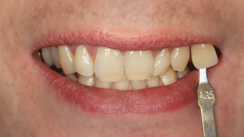 Zahnfarbe a3 zu dunkel