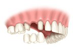 Einzelzahn Zahnimplantat mit Brücke