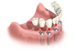 Zahnlos Implantatprothese