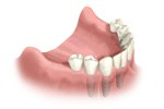 Zahnlos Implantatprothese - Fertigstellung