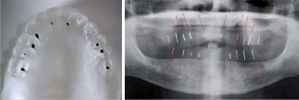 Abb. 5: Röntgenschablone – die Bohrlöcher sind mit röntgenopaker Guttapercha gefüllt. – Abb. 6: OPG mit Röntgenschablone zur Vermessung und Orientierung.